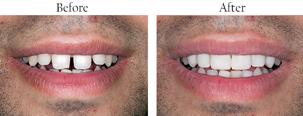 The image shows a side-by-side comparison of a person s teeth before and after dental treatment, highlighting the improvement achieved through cosmetic dentistry.