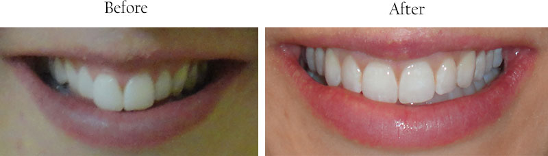 The image shows two side-by-side photographs of a person s smile before and after a cosmetic dental procedure, highlighting the transformation achieved by teeth whitening.