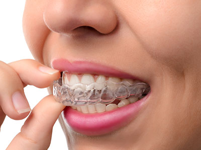 A person with a clear braces appliance on their teeth, holding it with both hands.