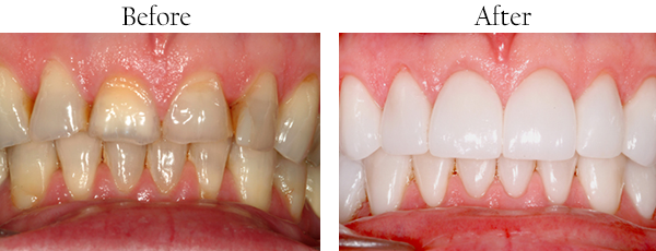 The image shows two side-by-side photographs of a person s teeth before and after dental treatment, highlighting the transformation from stained and yellowed teeth to cleaner and whiter ones.