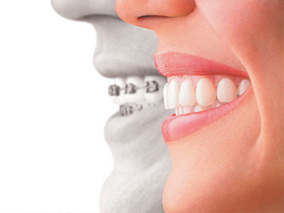 The image shows a split-screen comparison between a person s natural smile and a smile with dental implants, emphasizing the difference in appearance.